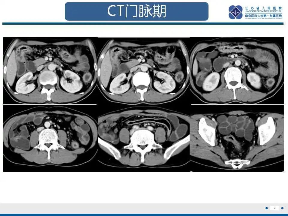 影像PPT - 【PPT】溃疡性结肠炎-5