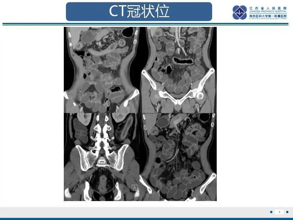 影像PPT - 【PPT】溃疡性结肠炎-6
