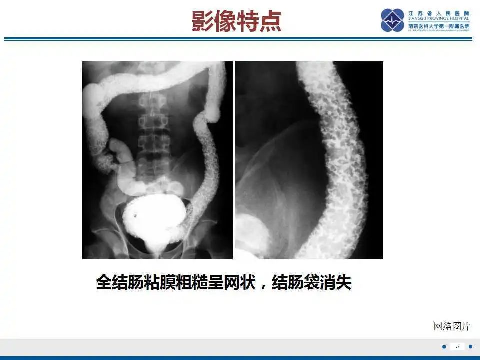 影像PPT - 【PPT】溃疡性结肠炎-22
