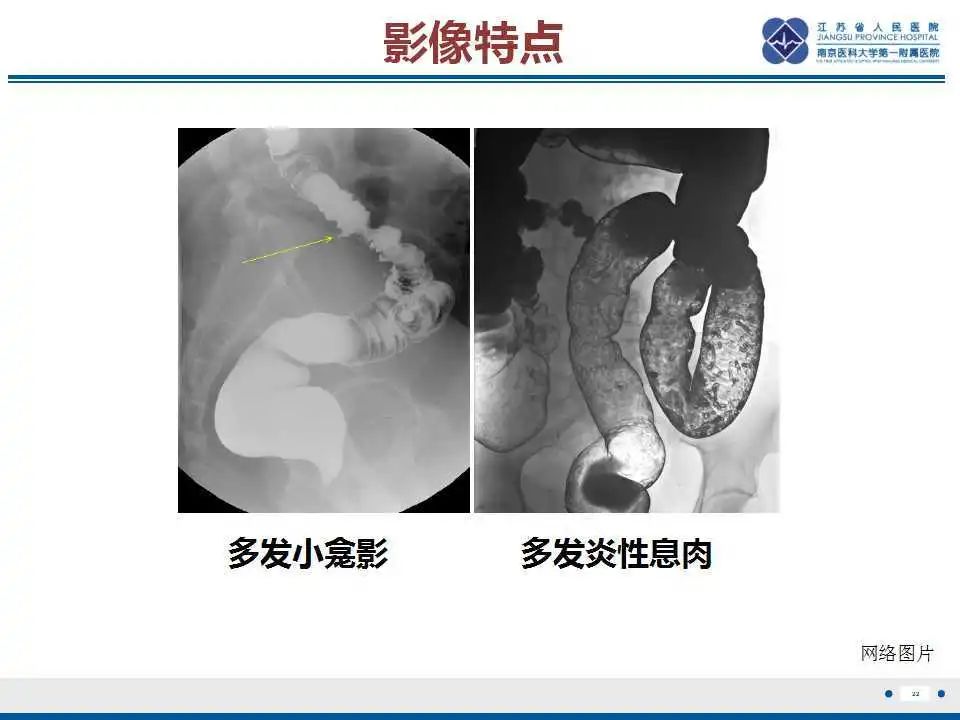 影像PPT - 【PPT】溃疡性结肠炎-23