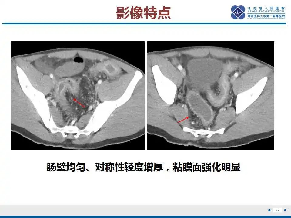 影像PPT - 【PPT】溃疡性结肠炎-25