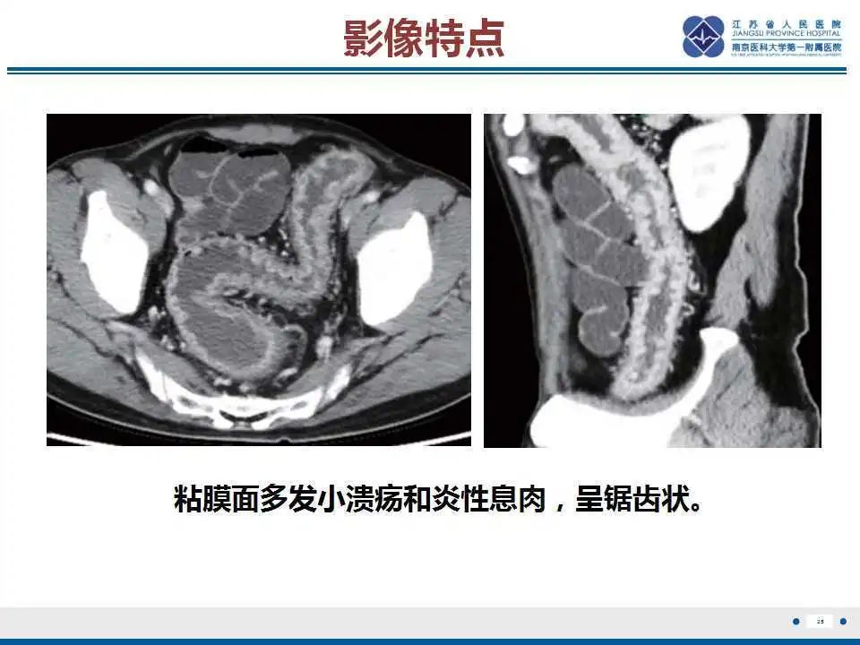 影像PPT - 【PPT】溃疡性结肠炎-26