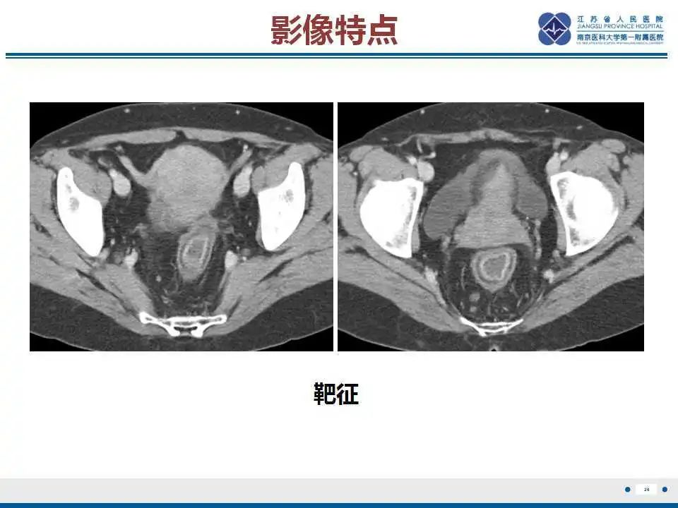 影像PPT - 【PPT】溃疡性结肠炎-27
