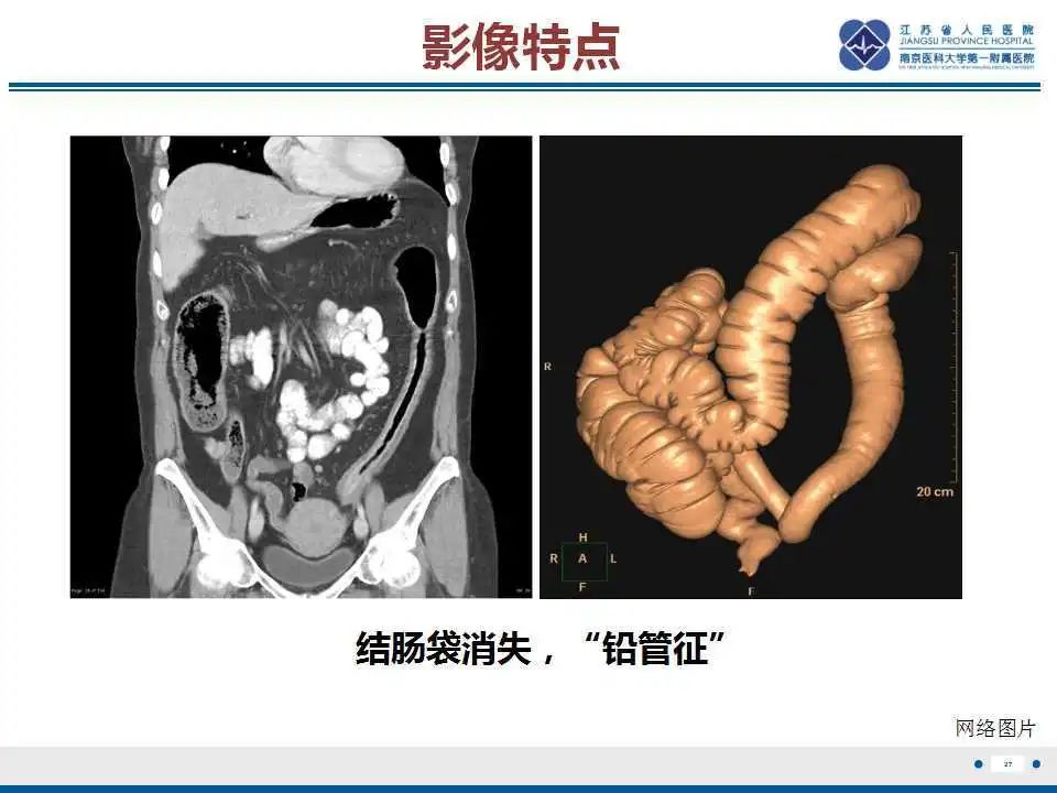 影像PPT - 【PPT】溃疡性结肠炎-28