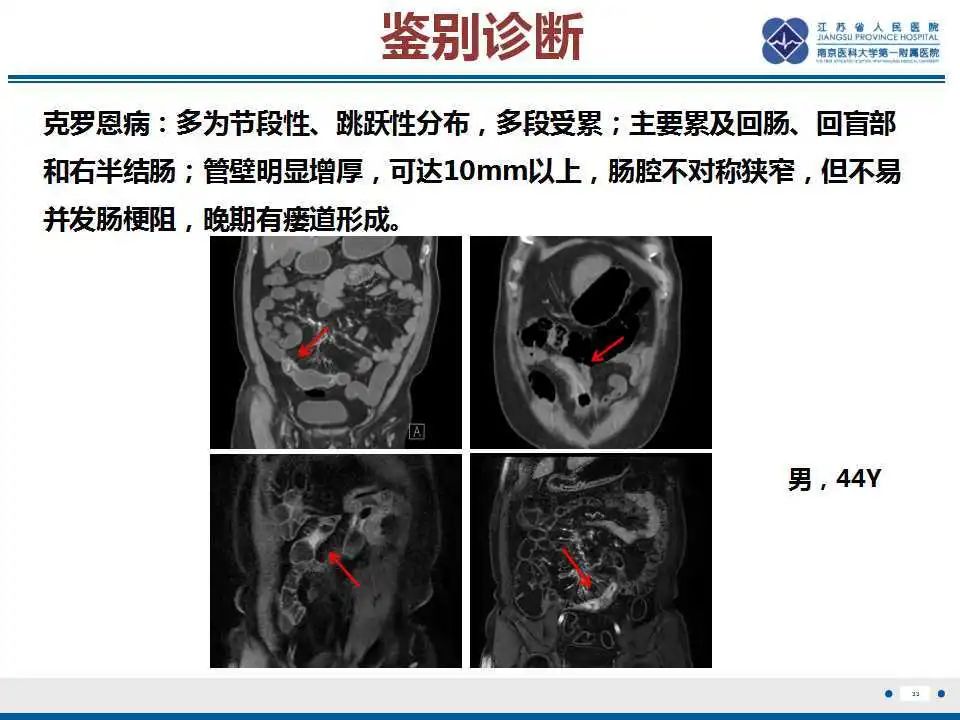 影像PPT - 【PPT】溃疡性结肠炎-34