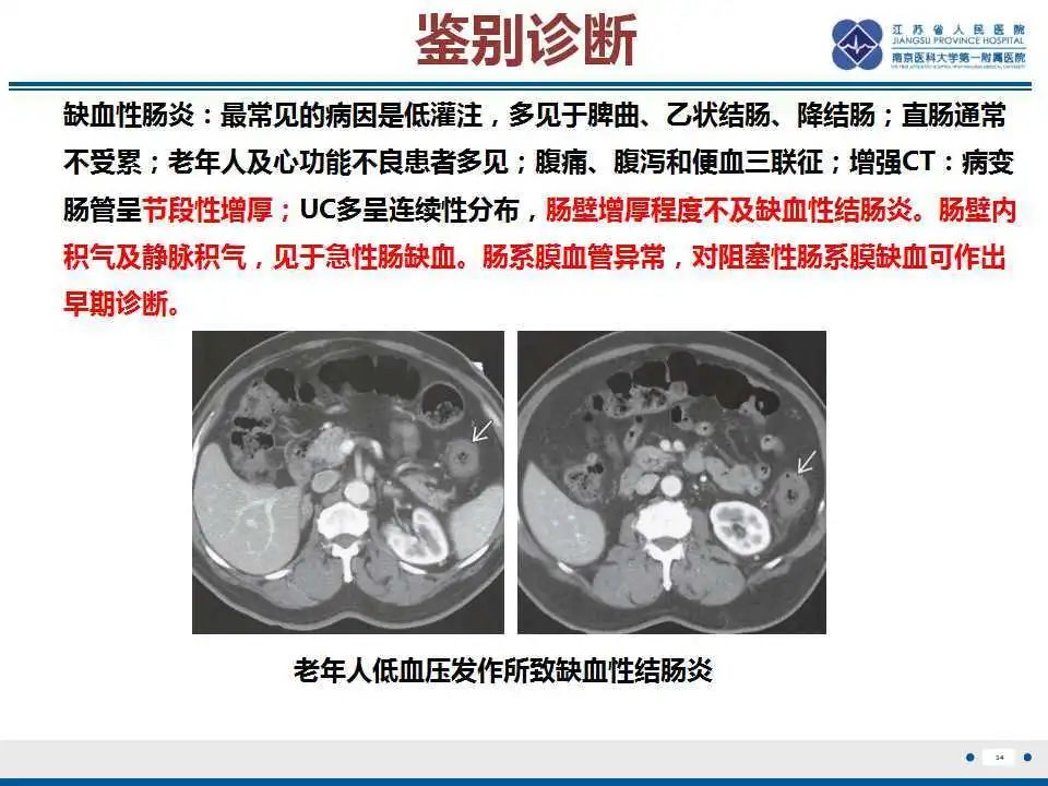 影像PPT - 【PPT】溃疡性结肠炎-35