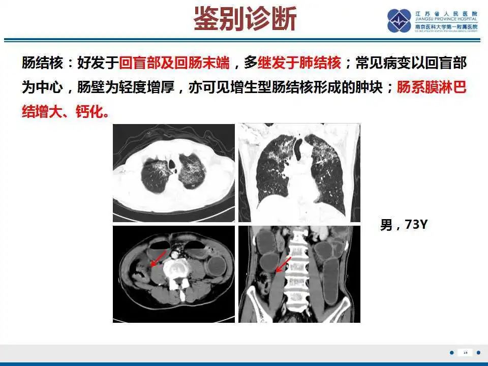 影像PPT - 【PPT】溃疡性结肠炎-36