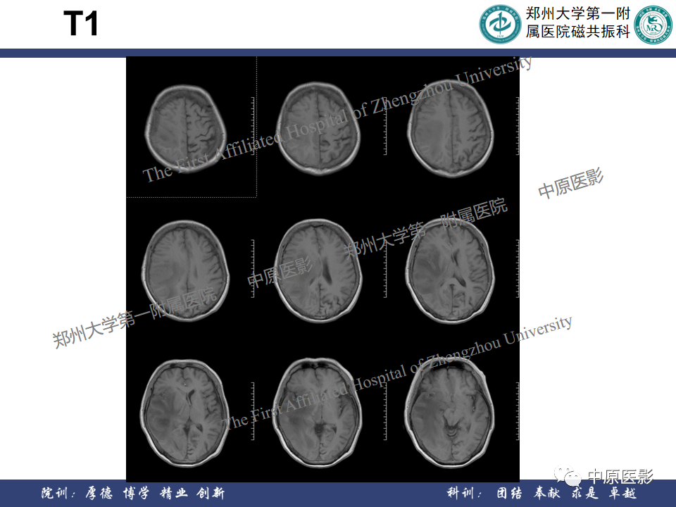 影像PPT - 【病例】原发性中枢神经系统淋巴瘤1例MR影像-4