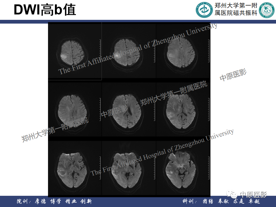 影像PPT - 【病例】原发性中枢神经系统淋巴瘤1例MR影像-5