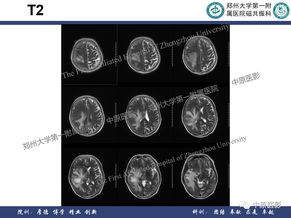 影像PPT - 【病例】原发性中枢神经系统淋巴瘤1例MR影像-3