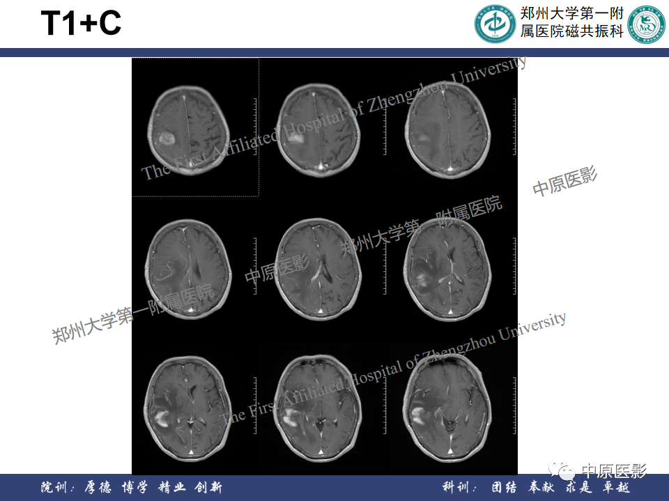 影像PPT - 【病例】原发性中枢神经系统淋巴瘤1例MR影像-7