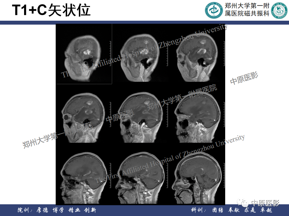 影像PPT - 【病例】原发性中枢神经系统淋巴瘤1例MR影像-8