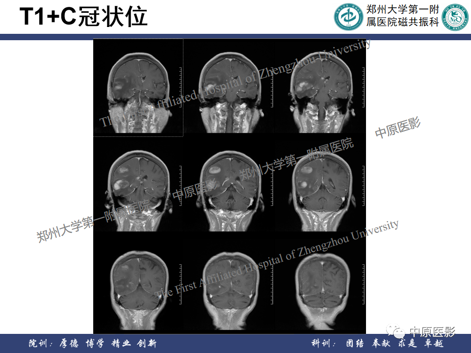 影像PPT - 【病例】原发性中枢神经系统淋巴瘤1例MR影像-9