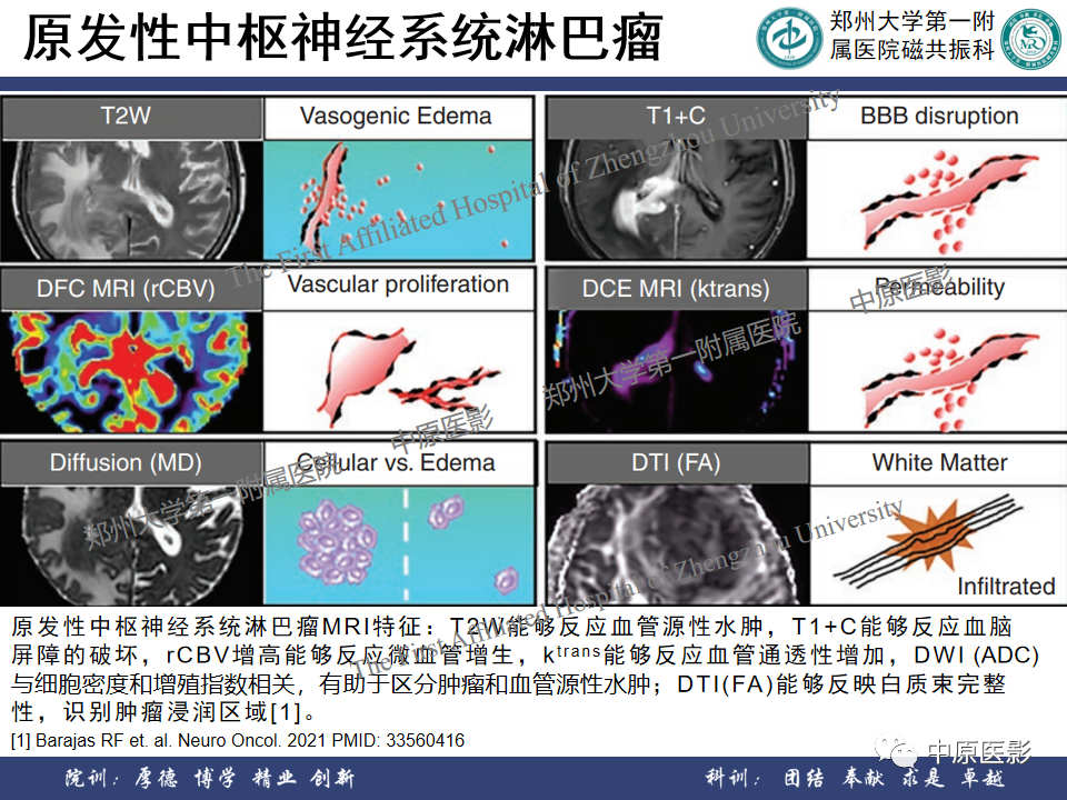 影像PPT - 【病例】原发性中枢神经系统淋巴瘤1例MR影像-14