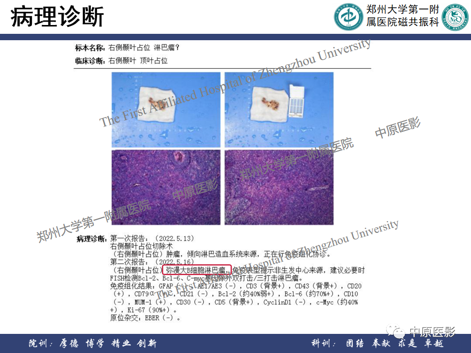 影像PPT - 【病例】原发性中枢神经系统淋巴瘤1例MR影像-12
