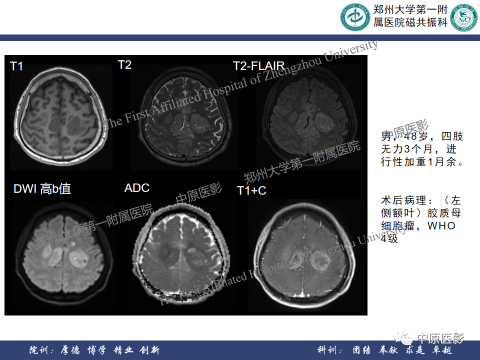 影像PPT - 【病例】原发性中枢神经系统淋巴瘤1例MR影像-17
