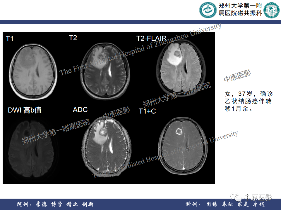 影像PPT - 【病例】原发性中枢神经系统淋巴瘤1例MR影像-19