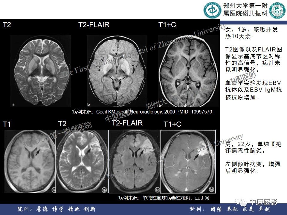 影像PPT - 【病例】原发性中枢神经系统淋巴瘤1例MR影像-21