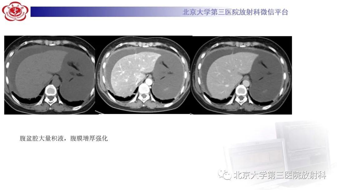 影像PPT - 【PPT】阑尾粘液性肿瘤-4