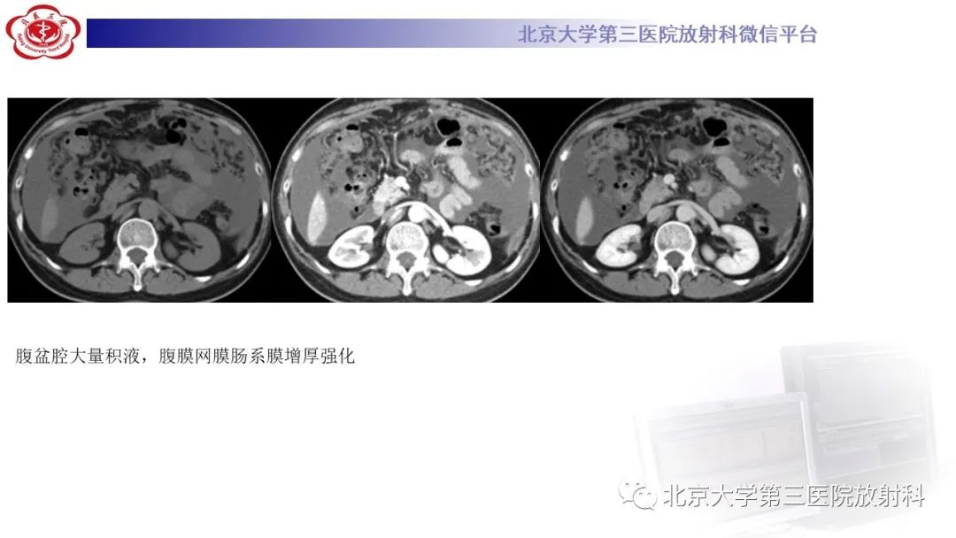 影像PPT - 【PPT】阑尾粘液性肿瘤-5