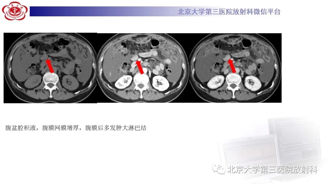 影像PPT - 【PPT】阑尾粘液性肿瘤-6