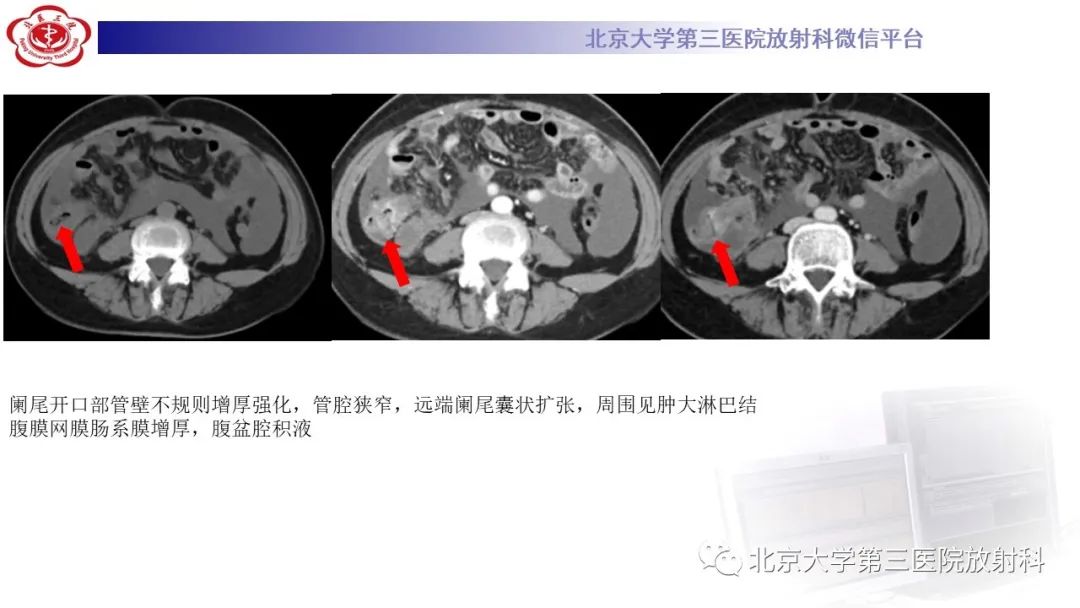 影像PPT - 【PPT】阑尾粘液性肿瘤-7