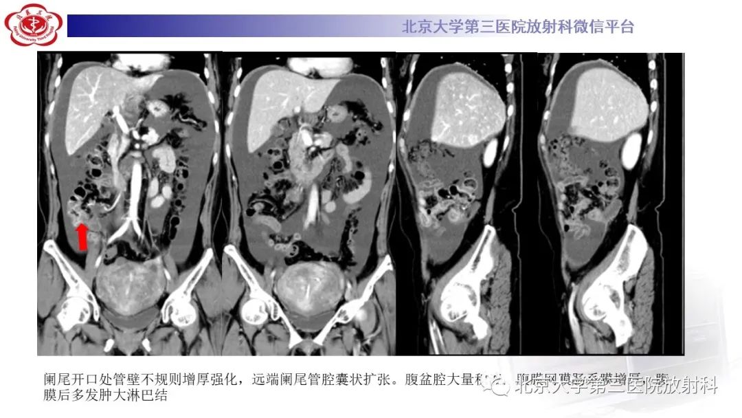 影像PPT - 【PPT】阑尾粘液性肿瘤-8