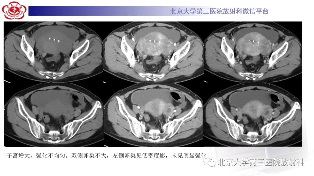 影像PPT - 【PPT】阑尾粘液性肿瘤-9