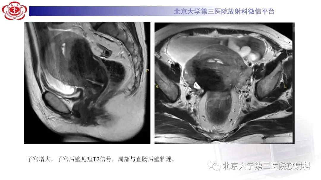 影像PPT - 【PPT】阑尾粘液性肿瘤-10