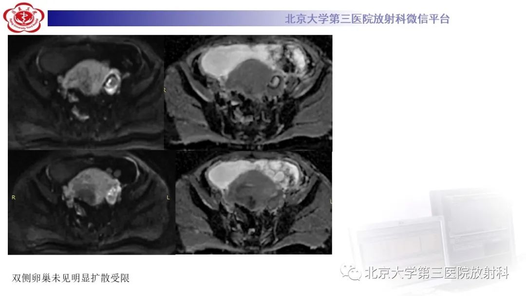 影像PPT - 【PPT】阑尾粘液性肿瘤-12