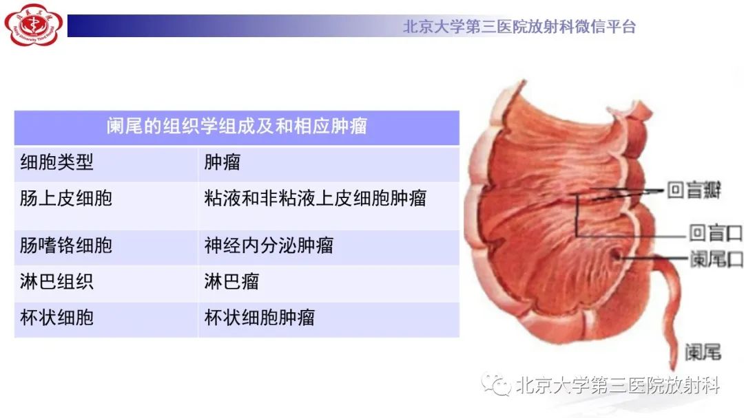 影像PPT - 【PPT】阑尾粘液性肿瘤-20