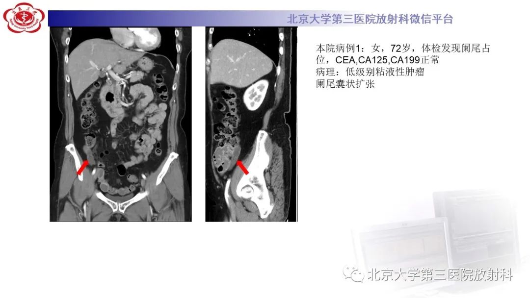 影像PPT - 【PPT】阑尾粘液性肿瘤-28