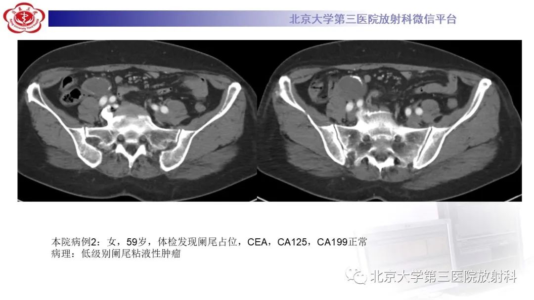 影像PPT - 【PPT】阑尾粘液性肿瘤-29