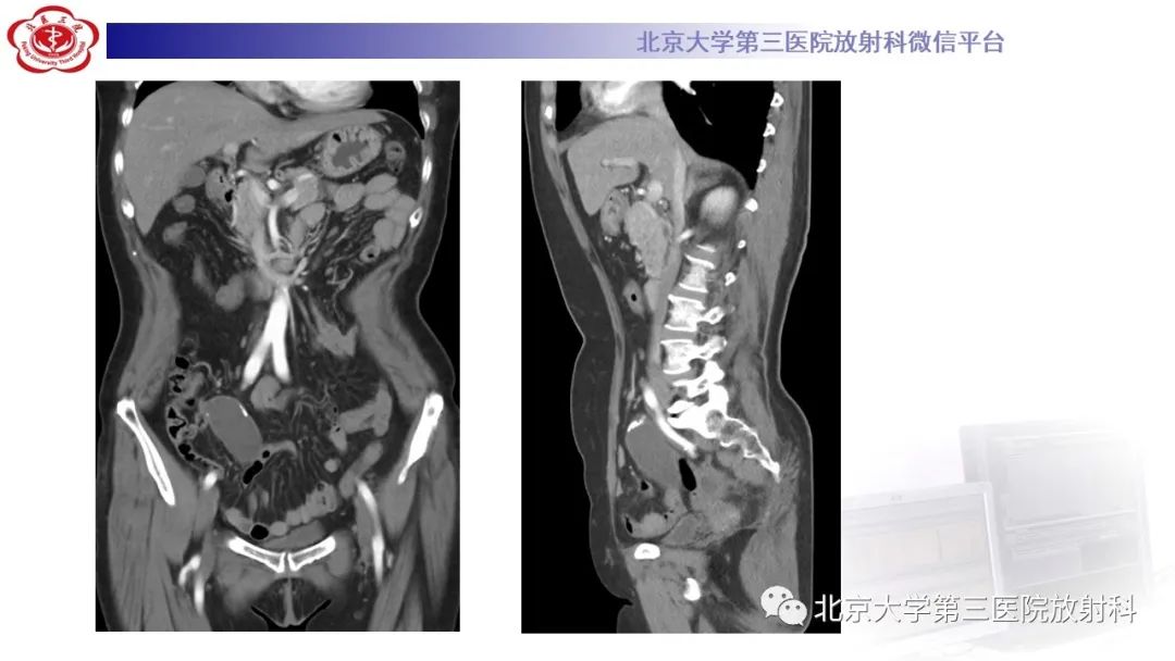 影像PPT - 【PPT】阑尾粘液性肿瘤-30
