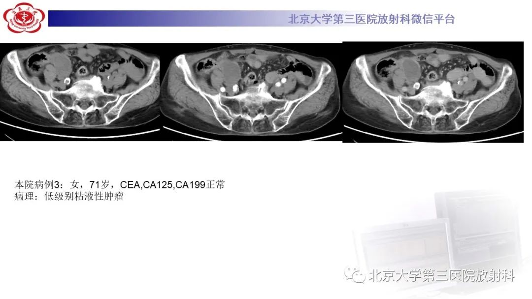 影像PPT - 【PPT】阑尾粘液性肿瘤-31