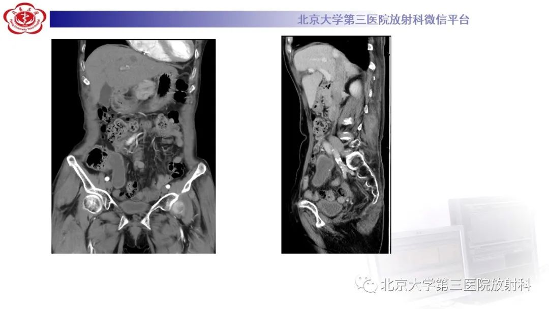 影像PPT - 【PPT】阑尾粘液性肿瘤-32