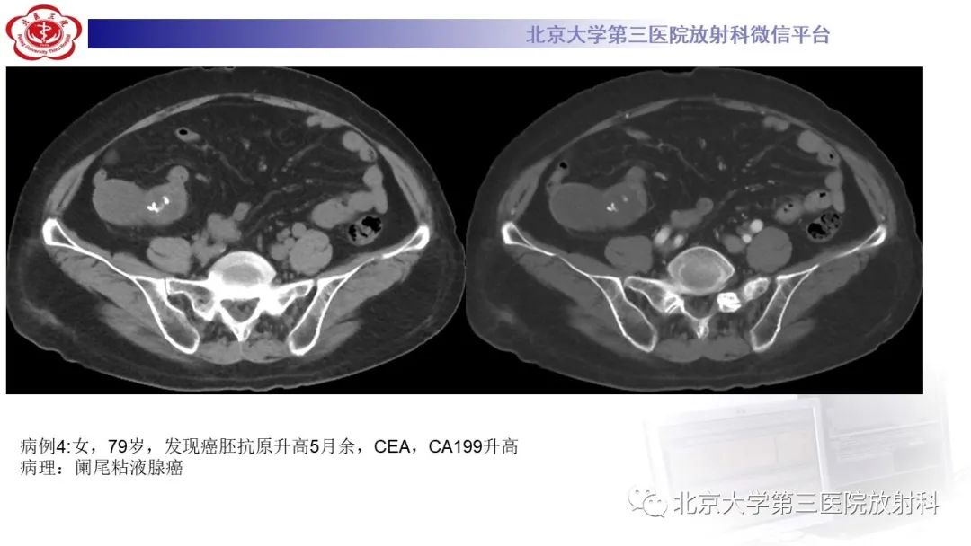 影像PPT - 【PPT】阑尾粘液性肿瘤-33