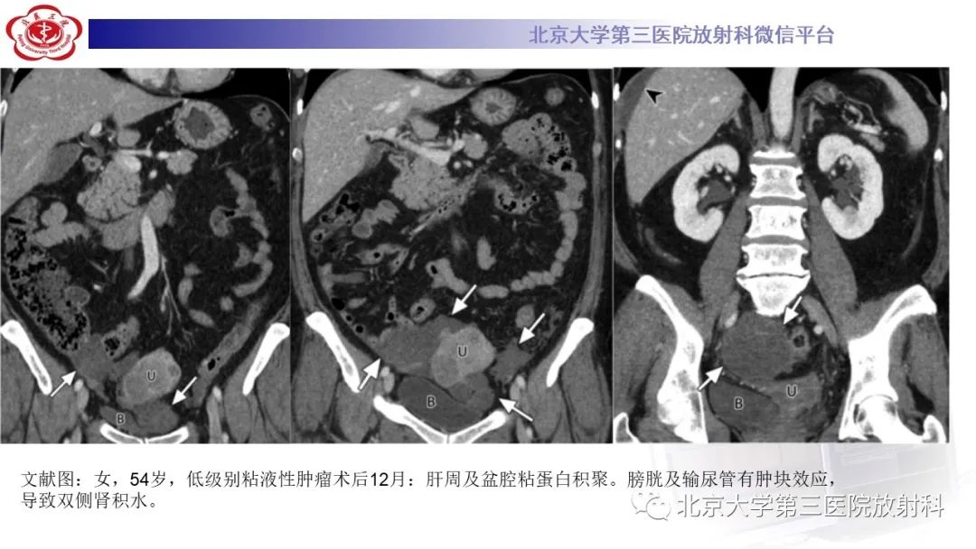 影像PPT - 【PPT】阑尾粘液性肿瘤-36