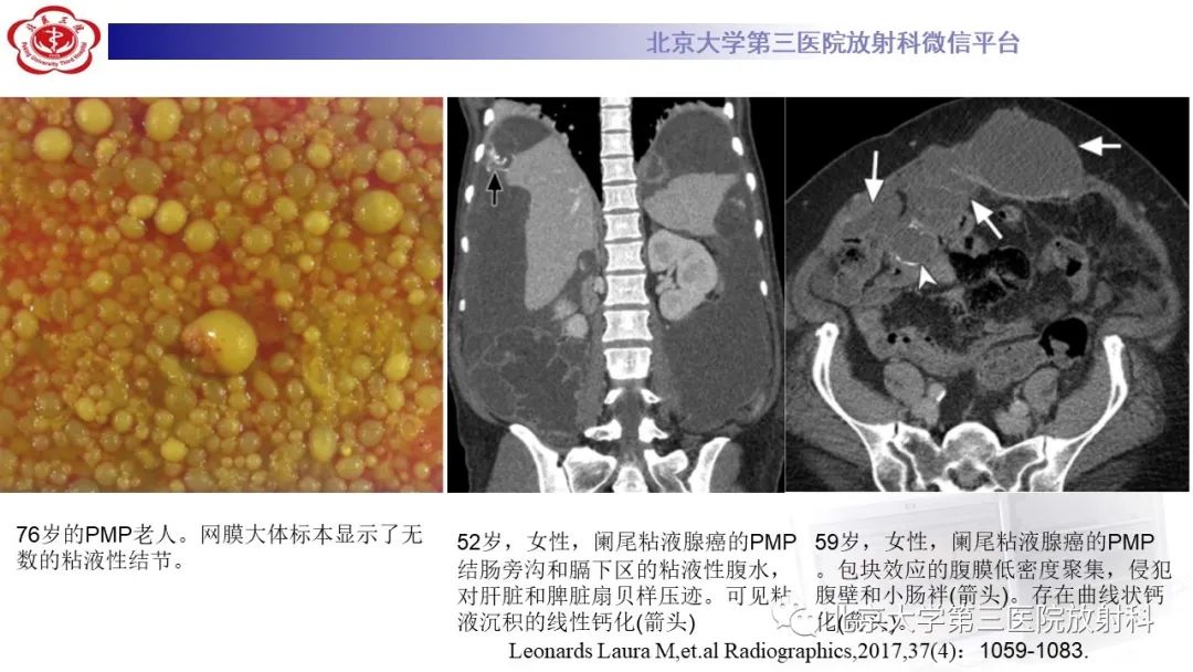 影像PPT - 【PPT】阑尾粘液性肿瘤-37