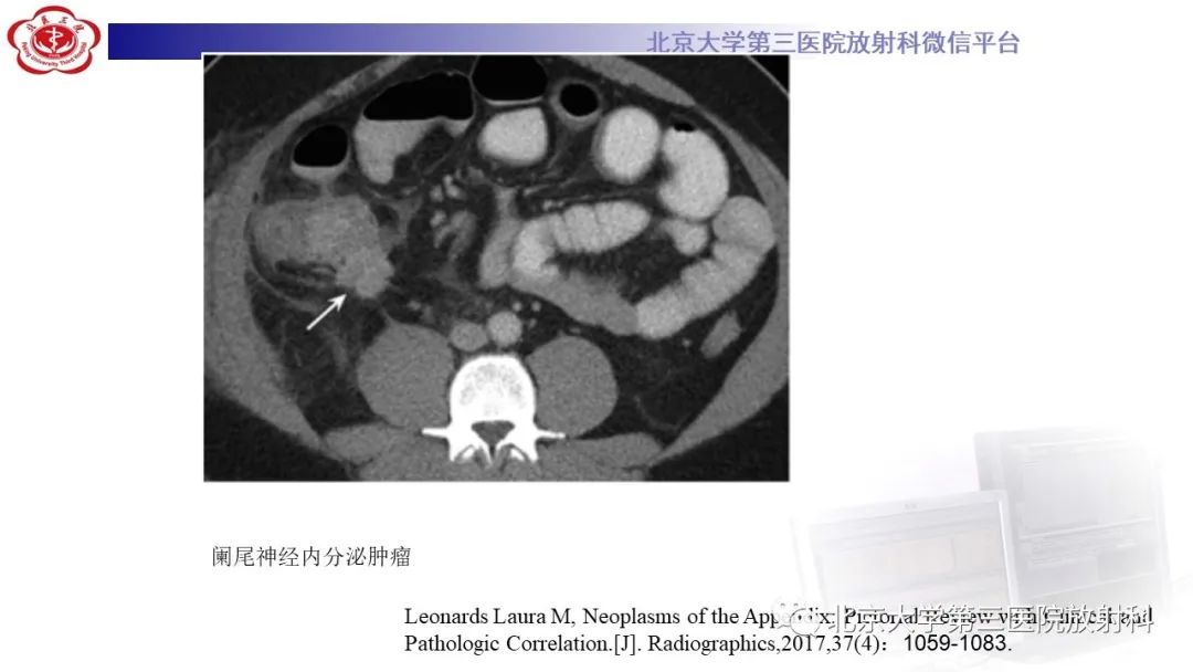 影像PPT - 【PPT】阑尾粘液性肿瘤-42