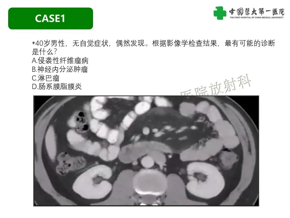 影像PPT - 【PPT】肠系膜病变的要点及鉴别诊断-4