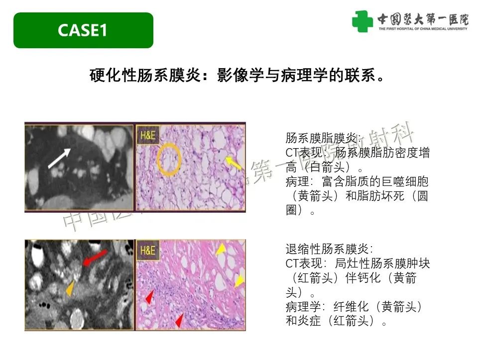 影像PPT - 【PPT】肠系膜病变的要点及鉴别诊断-6