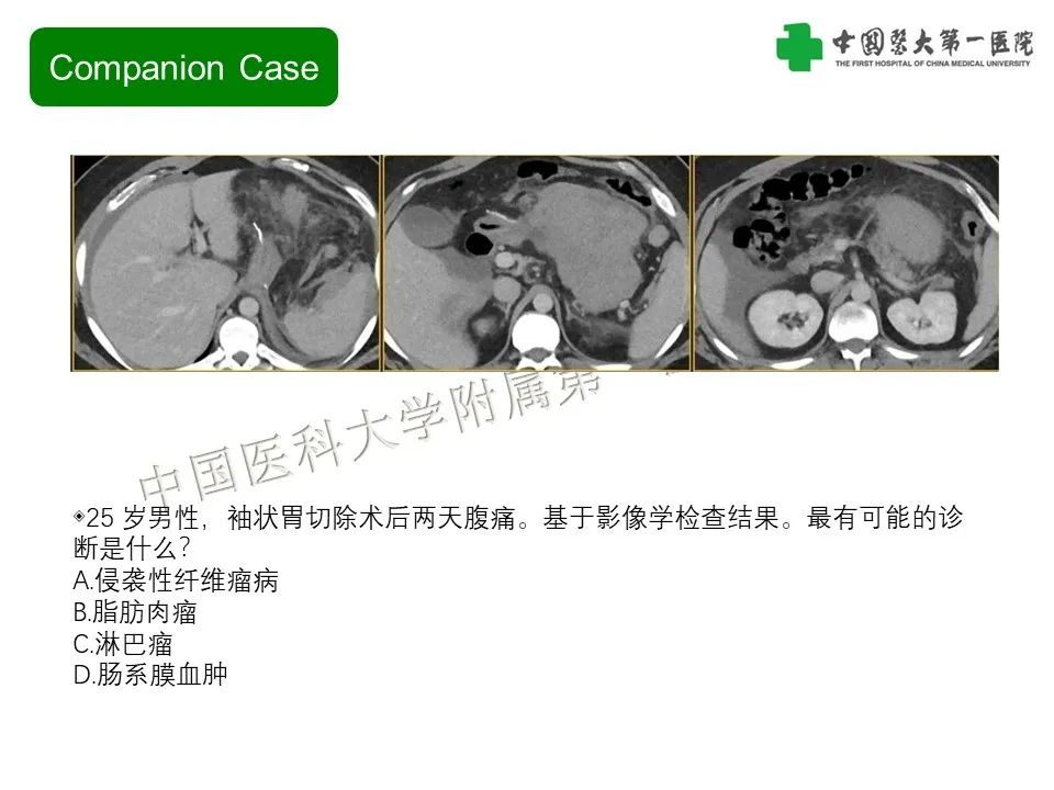 影像PPT - 【PPT】肠系膜病变的要点及鉴别诊断-12