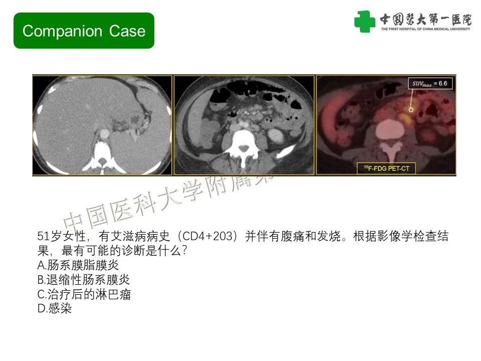 影像PPT - 【PPT】肠系膜病变的要点及鉴别诊断-14
