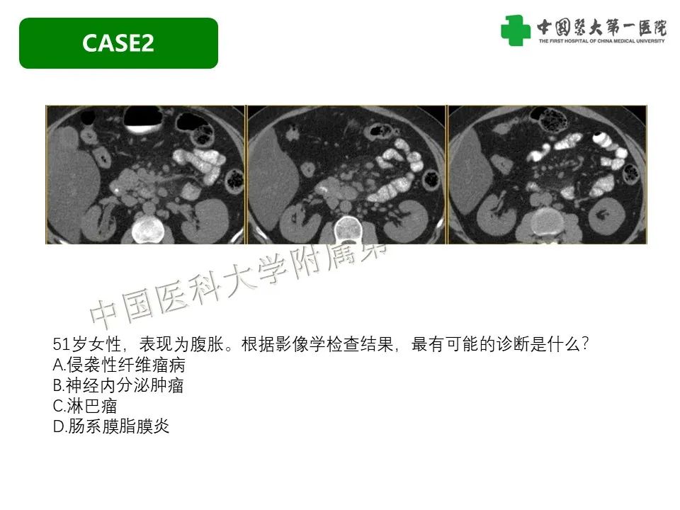 影像PPT - 【PPT】肠系膜病变的要点及鉴别诊断-17