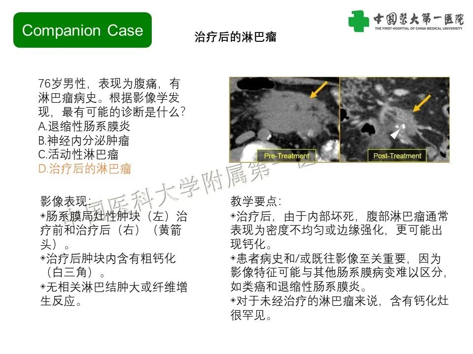 影像PPT - 【PPT】肠系膜病变的要点及鉴别诊断-22