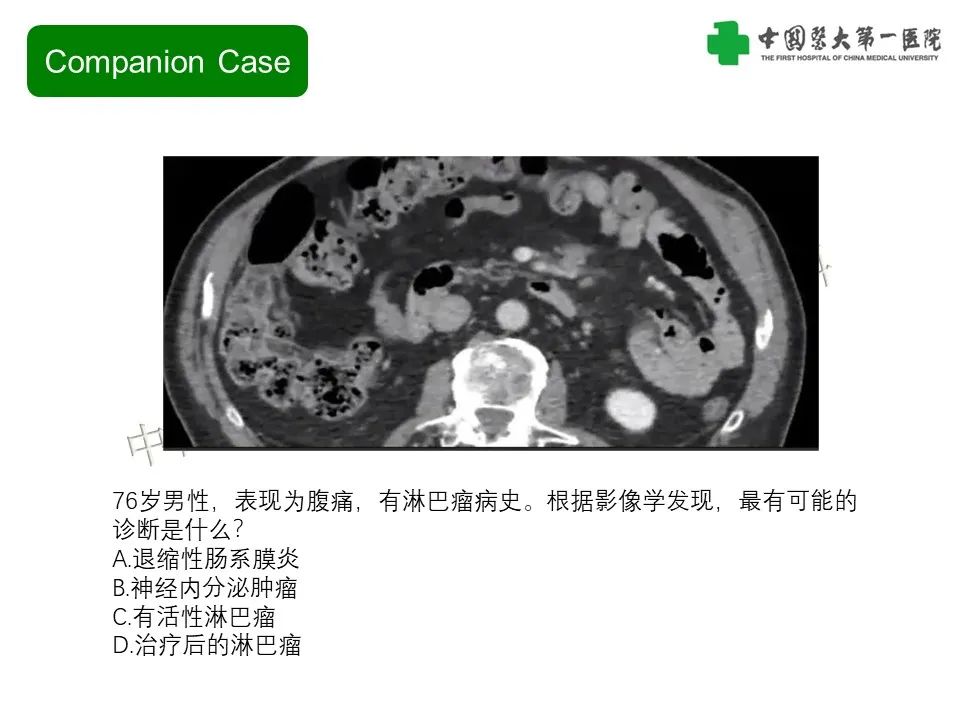 影像PPT - 【PPT】肠系膜病变的要点及鉴别诊断-21