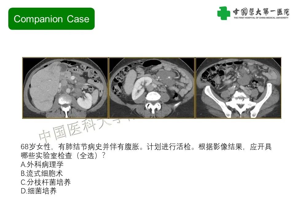 影像PPT - 【PPT】肠系膜病变的要点及鉴别诊断-23