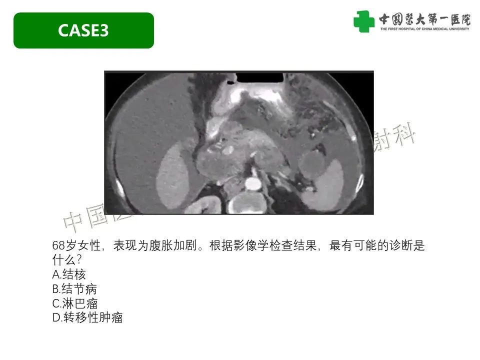 影像PPT - 【PPT】肠系膜病变的要点及鉴别诊断-25
