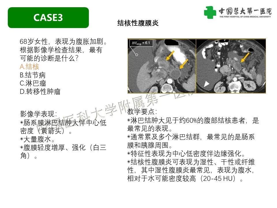 影像PPT - 【PPT】肠系膜病变的要点及鉴别诊断-26